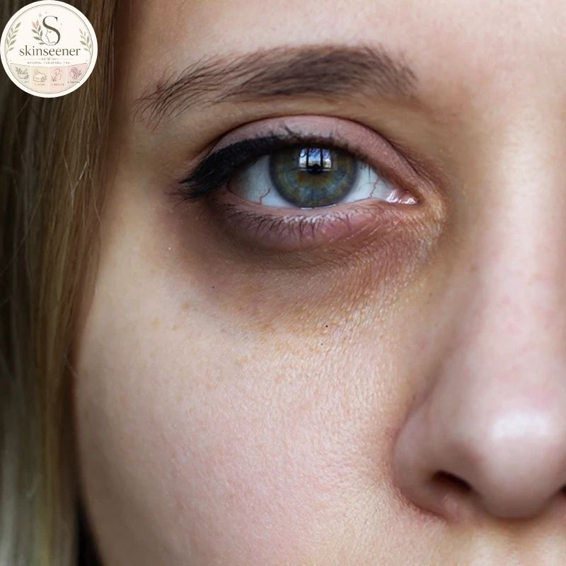 What Are Dark Circles?