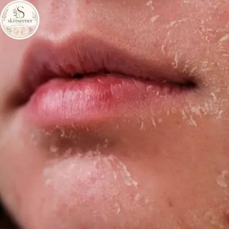 Common Causes of Dry Skin